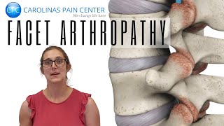 Natalie Explains Facet Arthropathy [upl. by Attenol]