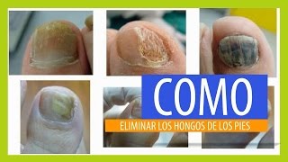 Elimina Los Hongos De Los Pies [upl. by Thier]