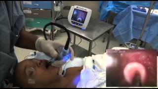 GlideScope Pediatric Airway Rounds Case Study 3 year old Umbilical Hernia Repair [upl. by Ocker700]