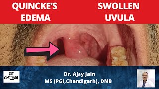 Swelling of uvula  Quincke Edema  Angioneurotic oedema  Uvula Functions  Causes  Management [upl. by Econah]