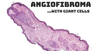 Angiofibroma fibrous papule with multinucleated giant cells pathology dermatopathology [upl. by Phene]