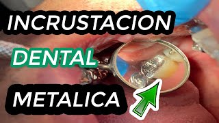 COMO se hacen las INCRUSTACIONES DENTALES METALICAS  Incrustación dental  Restauración de muela 🦷 [upl. by Sucirdor]