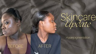 Update hyper pigmentation  This product 🔥 [upl. by Eca301]