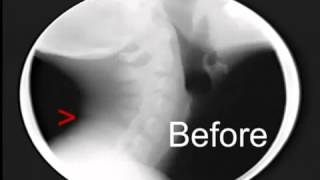 Neck Treatment under Motion X ray with the Arthrostim [upl. by Iahk498]