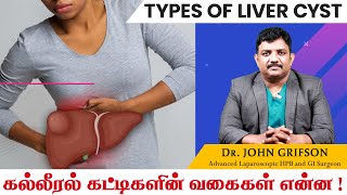 கல்லீரல் கட்டி காரணங்கள் அறிகுறிகள் சிகிச்சைகள் Types of Liver Cyst in Tamil  John Gastro Hospital [upl. by Vijar]