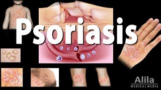 Psoriasis Types Symptoms Causes Pathology and Treatment Animation [upl. by Irollam]