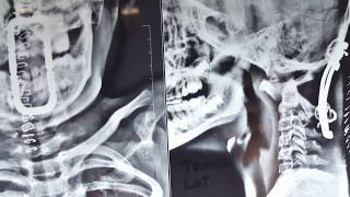 atlantoaxial dislocation lateral neck x ray seen in downs syndrome [upl. by Leakcim]