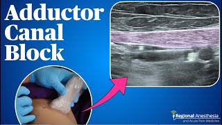 Adductor Canal Block 2024 update [upl. by Zurciram889]