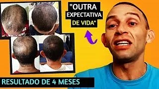 O ADRIANO VENCEU A CALVÍCIE E QUEDA CAPILAR EM APENAS 4 MESES DE TRATAMENTO [upl. by Brnaba]