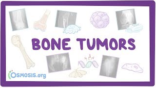 Bone tumors  causes symptoms diagnosis treatment pathology [upl. by Nishom602]