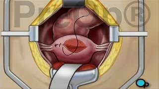 Myomectomy for Fibroids Surgery PreOp® Patient Education [upl. by Lissa972]