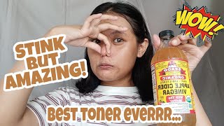 5 DAYS APPLE CIDER VINEGAR TONER ON ACNE PRONE SKIN REVIEW  English [upl. by Merralee]