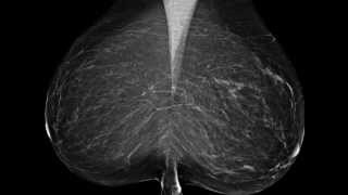 Case Studies in Digital Breast Tomosynthesis Fatty Breast [upl. by Berkshire]