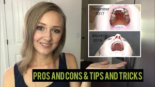 Palate Expander As An Adult Pros and Cons amp Tips and Tricks BEFORE AND AFTER [upl. by Areit]