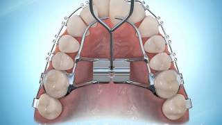 Hyrax Rapid Palatal Expansion Braces During [upl. by Dedrick]