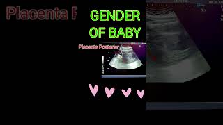 BABY GENDER VS PLACENTA shortsfeedpregnancy [upl. by Ynnal581]