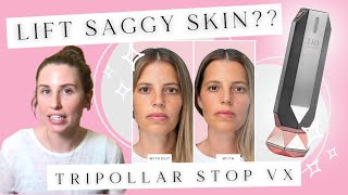 Skin Tightening At Home Tripollar STOP VX REVIEW  Does At Home Radio Frequency Treatment Work [upl. by Udall81]