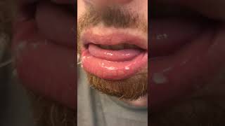 Dry Peeling Lips Exfoliative Cheilitis  Startover Day 3 [upl. by Brantley]