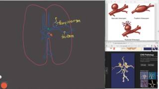 Subarachnoid Hemorrhage [upl. by Pinebrook]