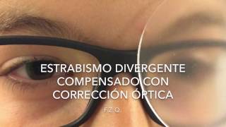 Estrabismo divergente compensado con corrección óptica [upl. by Einolem]