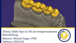 EXOCAD TUTORIAL 2016 TABLE TOPS im UK zur semipermanenten Bisserhöhung [upl. by Ardnik]