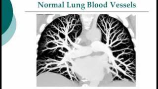 Your Radiologist Explains Computed Tomography CT Pulmonary Embolism [upl. by Gustafson]