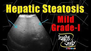 Mild Hepatic Steatosis  GradeI Fatty Liver  Ultrasound  Case 226 [upl. by Buehler]