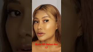 Brow lift Botox day 17th [upl. by Idhem]