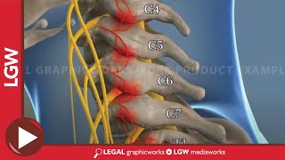 Cervical Radio Frequency Ablation animated surgery recreation [upl. by Colleen716]