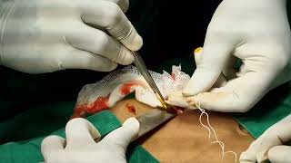 Open Appendectomy  Live surgical video [upl. by Muhcan]