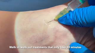 Microsclerotherapy for thread veins [upl. by Htur]