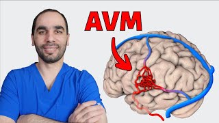 Arteriovenous Malformation AVM Causes Testing and Treatment [upl. by Lucias]