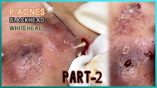 Big Cystic Acne Blackheads Extraction Blackheads amp Milia Whiteheads Removal Pimple Popping [upl. by Lynett]