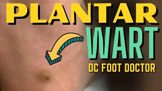 Plantar Wart Verruca Plantaris [upl. by Benn]