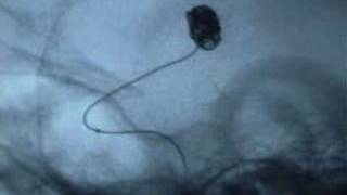 Coil embolization of aneurysm [upl. by Neona409]