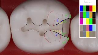 Class II Amalgam 19 MO Acadental  Amalgam Preparation Technique [upl. by Airotna]