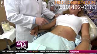 Stretch Mark Removal Demo on Good Day LA [upl. by Eddi]