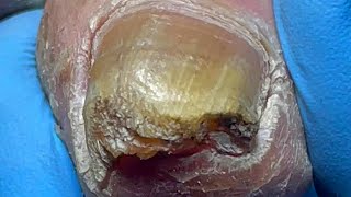 Curly ingrown nails poor onychomycosis【Pedicure Master Lin Jun】 [upl. by Novoj717]