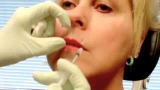 Treatment of smokers lines with Botox [upl. by Leacock]