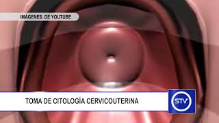 TOMA DE CITOLOGÍA CERVICOUTERINA [upl. by Mareah]