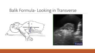 Tutorial USGuided Thoracentesis [upl. by Ahsircal]