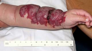 Infantile Hemangiomas aka “Strawberry” Birthmarks [upl. by Grogan]