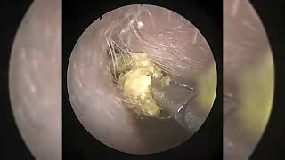 ear wax removal ear wax removal asmr ear wax removal india ear wax removal videos ear wax remova [upl. by Harleigh]