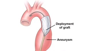 The Changing Treatment of Thoracic Aortic Aneurysms [upl. by Udenihc691]