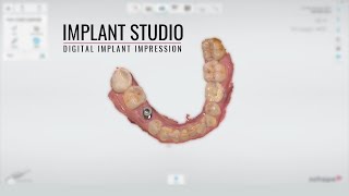 3Shape Trios Implant Impression [upl. by Ardnua]