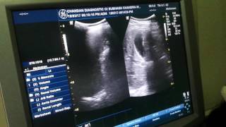 Chronic cystitis Ultrasound [upl. by Ivonne]