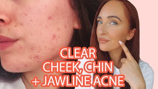 HOW TO GET RID OF CHIN CHEEK JAWLINE ACNE  Tips For Balancing Hormones  NUTRITIONIST [upl. by Oicaro]