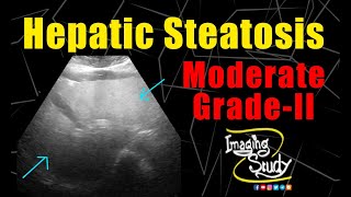 Moderate Hepatic Steatosis  GradeII Fatty Liver  Ultrasound  Case 222 [upl. by Uyekawa]