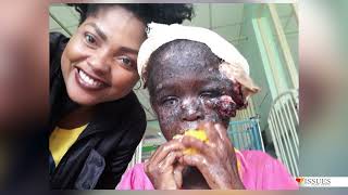 Childrens Skin Diseases Xeroderma pigmentosum Issues Pane Nyaya [upl. by Haerdna]