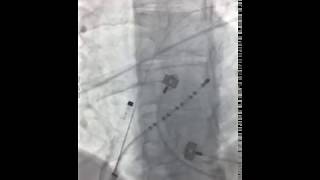 AF ablation with Rhythmia system [upl. by Eireva770]